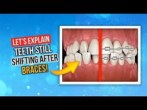 Why Do Teeth Shift After Braces?