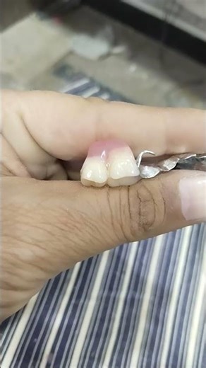 Upper Removable Cost Partial Denture 😁😁😁#rpddentalprocedure #partialdenture #shortvideo #viralvideo