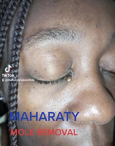 For mole removal,visit any of Maharaty laser clinic branches at only...