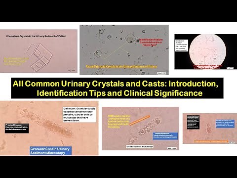 All common Crystals and Casts of Urine:Introduction, Identification and clinical significance