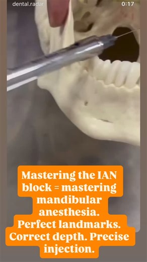 Dr adhya thakur arora on Instagram: "👀🦷“Ever wondered how we numb an entire half of the lower jaw? 👇” ➡️1. Patient Positioning • Patient supine or semi-supine • Mouth wide open • Operator stands: • Right side of patient for right IANB • In front/left side for left IANB ✅ Landmarks to Identify • Coronoid notch (greatest concavity on anterior border of ramus) • Pterygomandibular raphe • Occlusal plane of mandibular teeth • Contralateral premolars (for syringe alignment) ✅Needle Insertion Point 