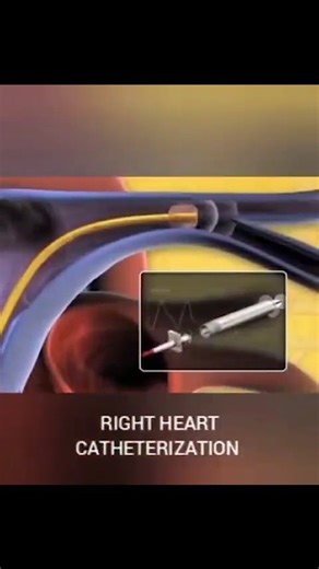 14K views · 55 reactions | Right heart catheterization animation In...