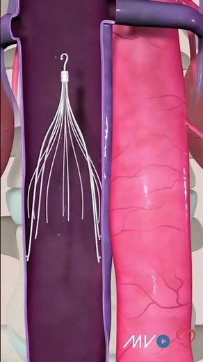 IVC filter placement via leg