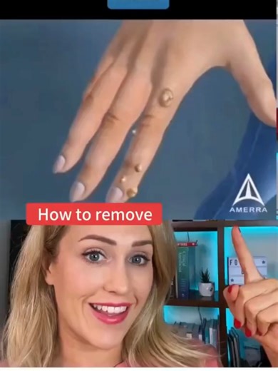 Rimuovi Verruche e Imperfezioni della Pelle - Siero Efficace