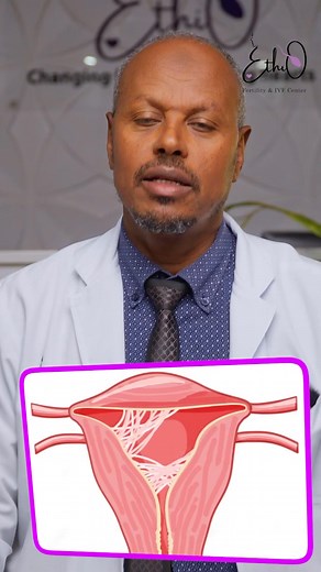 50K views · 1.2K reactions | Asherman Syndrome የማሀፀን ጠባሳ | Ethio Fertility & Ivf Center | Facebook