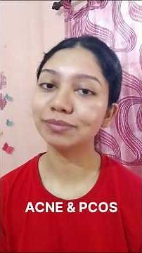 Nodular Acne😳 | Acne & Pcos | How to cure your nodular acne 🤔 #acne #pcos #nodules