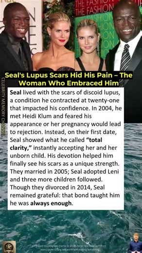 Seal's Lupus Scars Hid His Pain – The Woman Who Embraced Him