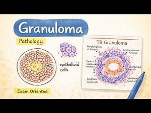 Granuloma l Chronic Inflammation l Pathology