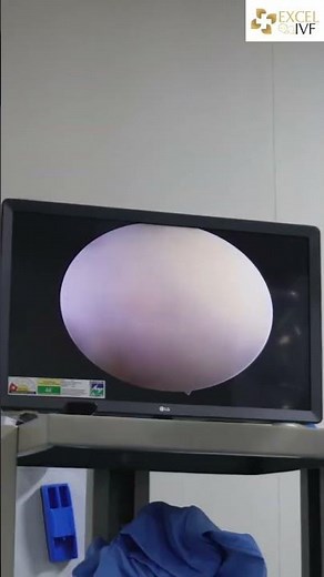 How Uterine Adhesions Affect Pregnancy: A Hysteroscopy Success Story | Dr Rhythm Gupta