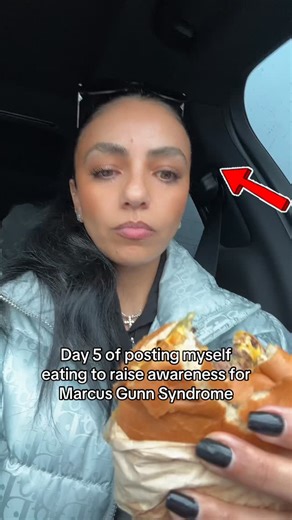 MARION on Instagram: "Marcus Gunn syndrome is a rare condition where one eyelid moves when you chew, talk, or eat. I’ve been learning so much while posting the last few days..some people are born with it, and some can develop it from Bell’s palsy. It’s not life-threatening, but the bullying is. Kids get made fun of, feel embarrassed, and their mental health really suffers..some even stop eating in public. And that breaks my heart. No one deserves to feel ashamed of something they can’t control.