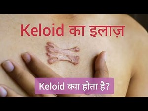 Keloid का इलाज | Hypertrophic Scar | Keloid treatment | keloid injection treatment | keloid scar