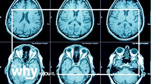 Why is social media use linked to brain changes in teens?
