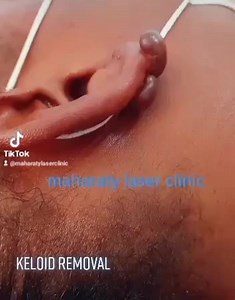 Maharaty Laser clinic offers treatments for the following skin...