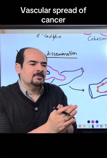 Tumor spread in vessles #pathology #medicalstudent #tumor #باثولوجي #fyp
