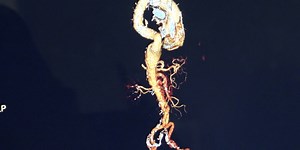 Medical Moment: The warning signs of an aortic aneurysm