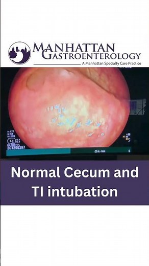 Normal Cecum and TI intubation - Colonoscopy Procedure #healthcare #gastroenterologist