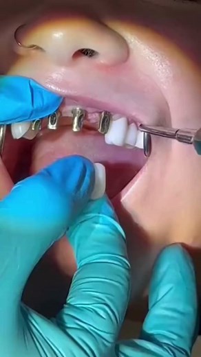 5 missing front 🦷! Dental Implants are the best option to replace 🦷. Yes, they are the most 💵, but worth it! #dentist #teeth #tooth #education