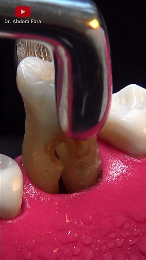 Tooth extraction procedure in 4k