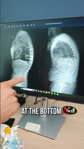 TLIF Use Case - Spine Surgery