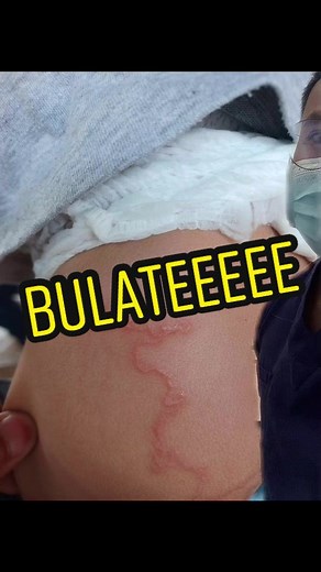 Cutaneous Larva Migrans Removal and Treatment