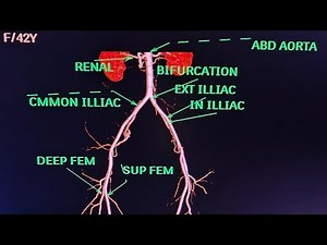 CT Lower Limb Angiography Anatomy CT scan.‪@Philips‬ ‪@avnishradiology‬Part-2