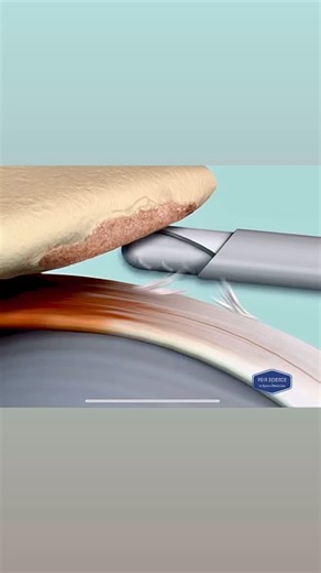 PainScience Sports Medicine on Instagram: "Arthroscopic subacromial decompression for spurs For educational purposes only. Video from the Mayo Clinic #exercise #sports #performance #medicine #injury #training #fitness #health #pain #strength #education #surgery #rehab #knee #hip #ankle #shoulder #spine #endurance #elite #athlete #bone #weight #muscle#vestibular #speed #acceleration #run #balance #sleep"