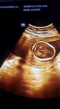 triploidy fetal ultrasound