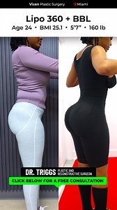 ✨ Lipo 360 BBL. Real Patient. Real Transformation. ✨ Lipo 360 BBL with Dr. Triggs 💎 She got her Lipo 360 BBL. A smaller waist, natural volume, and confidence that shows from every angle. Just real results from Dr. Triggs and the Vixen team. 💃🏽 | Dr. Triggs Miami