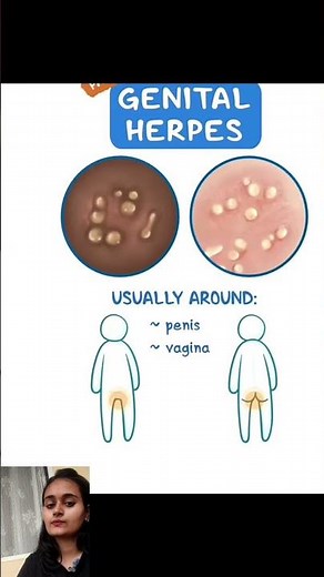 Genital Herpes: Facts, Symptoms & Treatment Explained!