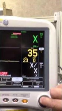 Capnography (EtCO2) Monitoring