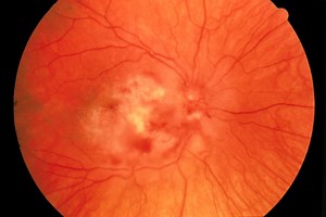 Retinitis: Tipos, Síntomas, Causas, Tratamiento - La Salud Ocular 2026