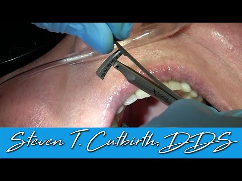 How to Properly Torque & Seat an Implant Crown - Dental Minute with Steven T. Cutbirth, DDS