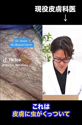 @Dr Jason Chouake @Dr Jason Chouake #duet マダニに噛まれた時の対処法を皮膚科医が解説！放置しないですぐ皮膚科へ受診しましょう #マダニ #感染症 #花房火月 #皮膚科医