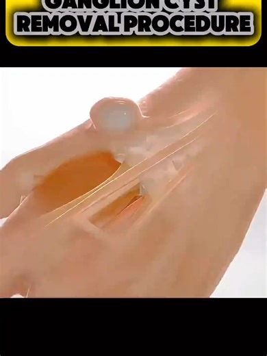 Understanding Tracheotomy Procedures in Throat Surgery