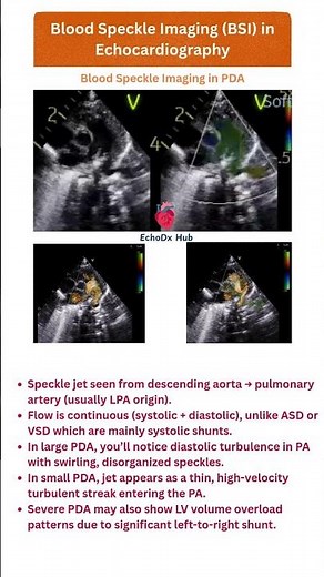 Blood Speckle Imaging in PDA #echocardiography