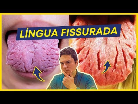 Fissured tongue: What is it? Is there a cure?