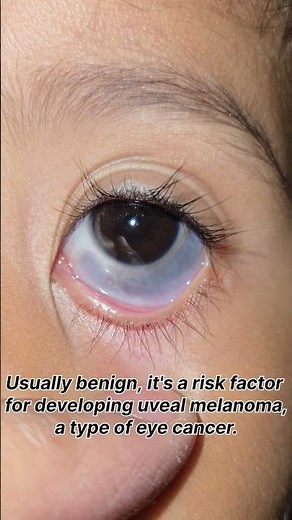 OCULAR MELANOSIS,Please dont Ignore It !!! #visioncaremeerut