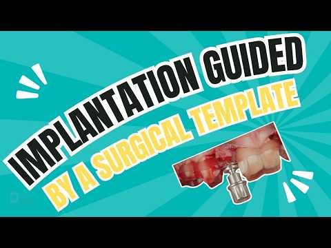 Implantation guided by a surgical template