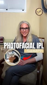 IPL Photofacial Treatment: Before and After Results