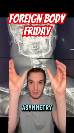 Retained IV needles in the neck causing an abscess