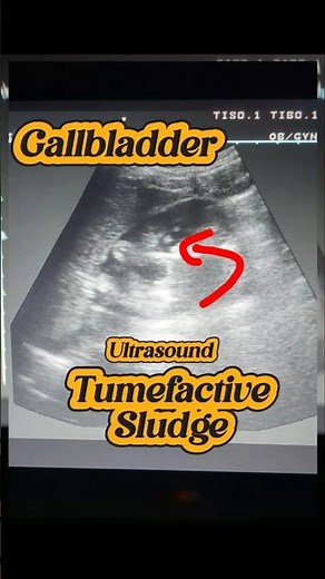 How to Ultrasound Gallbladder Tumefactive Sludge | Gallbladder and Liver Scan