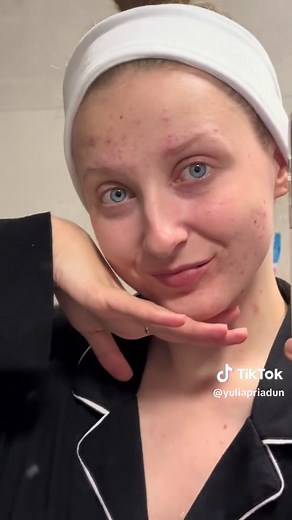 How to use Duac? #acne #лікуванняакне #acnefighter #acnejourney #duac #дуак #trądzik #лікуюакне