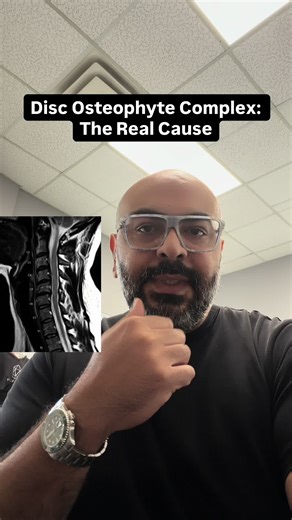 If your spine MRI says “disc osteophyte complex,” do not chalk it up to “just aging.” This is a targeted repair response to microinstability. As discs lose proteoglycans they dehydrate, lose height, and develop annular fissures; load shifts to the vertebral rim, endplates, uncovertebral joints, and facets. The spine tries to stabilize by laying down fibrocartilage that ossifies into marginal bone spurs (endochondral ossification). Paired with a bulging or herniated disc, those osteophytes can na