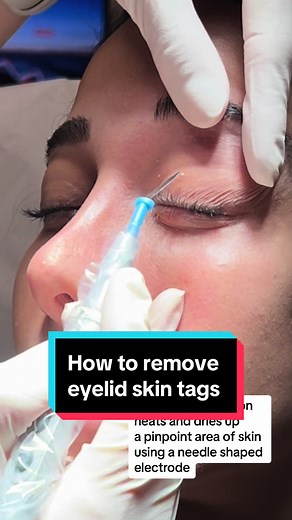 #skintagremoval from the #eyelids. #skintag #skintags #skintagsremoval #eyelid #seborrheickeratosis #electrodessication #curettage #eandc #electrocautery #fibrouspapule #angiofibroma #dermatology #skindoctor #skintok #cosmeticdoctor #cosmeticdermatology #aestheticdoctor #aestheticdermatology #vancouverskin #projectskinmd