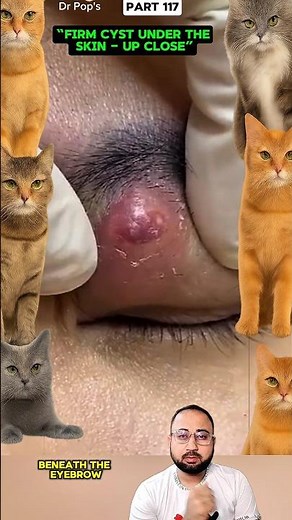 Eyebrow Cyst Up Close 👀 Firm and Compact Under the Skin #shortsfeed #shorts