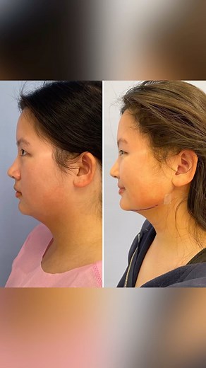 Submental liposuction or “neck lipo” removes excess fat under the chin can create dramatic and transformative results. As this beautiful patient of mine stated - it makes the jaw look snatched. I have developed a special multi-step liposuction technique that produces natural looking, smooth and dramatic results with little to no pain and a quick recovery. This is her ONE day after surgery! Look how unbelievably defined her jawline and neck are ❤️ #jawlinegoals #chinlipo #snatched #contour | Dr.