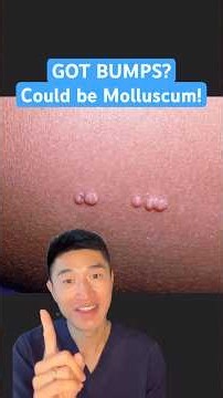 GOT BUMPS? They could be molluscum contagiosum! Here’s what to do from a dermatologist #dermatology
