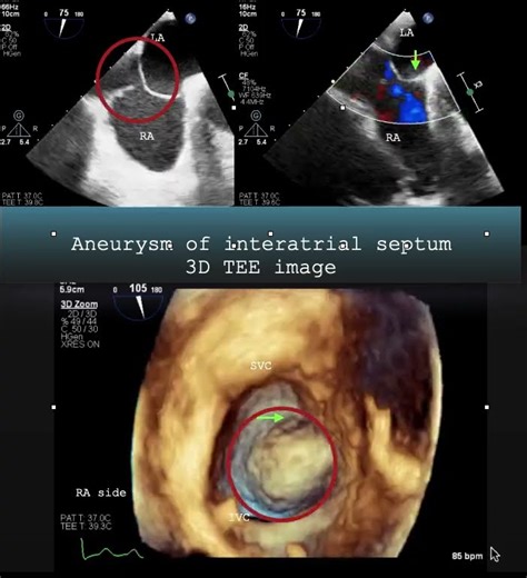 Aneurysm of interatrial septum 3D TEE image