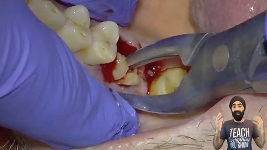 CLINICAL TUTORIAL: Upper Molar EXTRACTION with Electric Handpiece Section and Elevate FLAPLESS