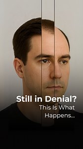 Are you still in denial about your hair loss? This video breaks down each stage of the Norwood Scale and explains what can be done at every point to protect and restore your hair. Don’t let denial keep you from doing what is right for your hair. The earlier you take precautions, the more options you have to maintain your hair before it is too late. Book your free consultation today at Vinci Hair Clinic and learn how you can take control of your hair health. #hairtransplant #hairloss #microscalpp